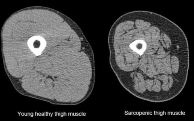 Sarcopenia and Locomotive Disorders in Sedentary City Lifestyle