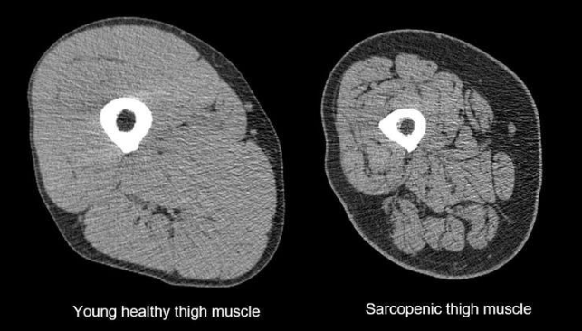 Sarcopenia and Locomotive Disorders in Sedentary City Lifestyle